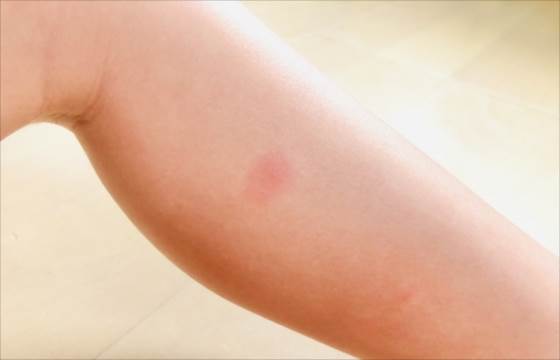 イエロージャケットの刺され治療